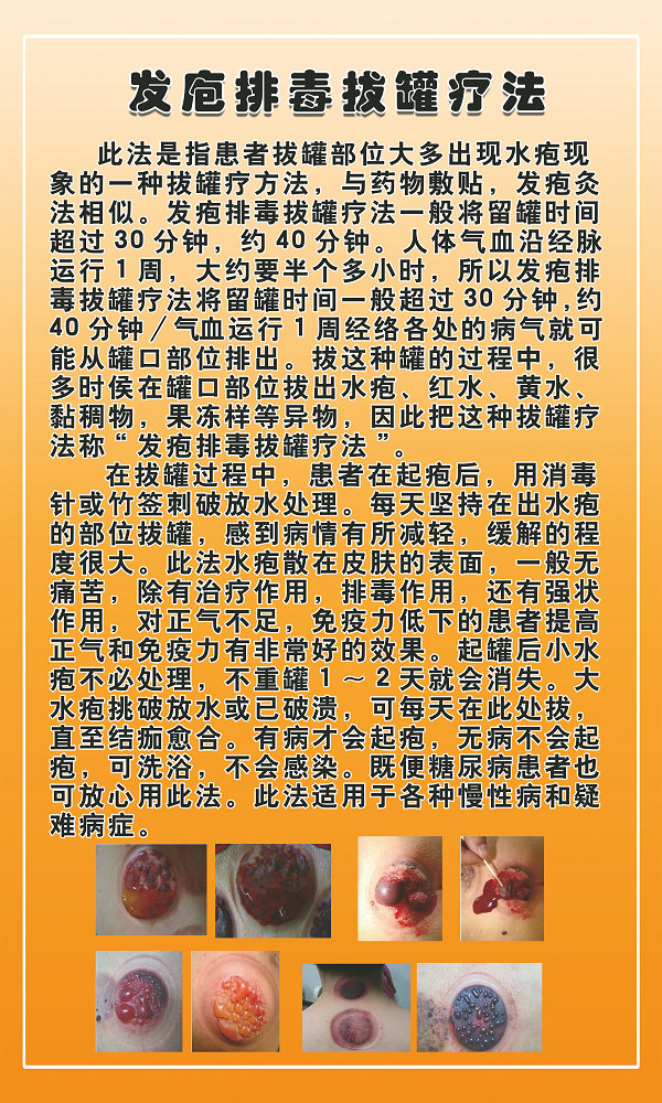 李华,发疱排毒,拔罐疗法